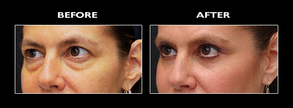 Eye opening surgery on sale