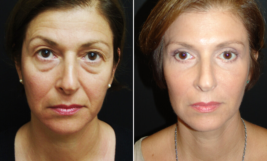 Before And After Blepharoplasty Surgery