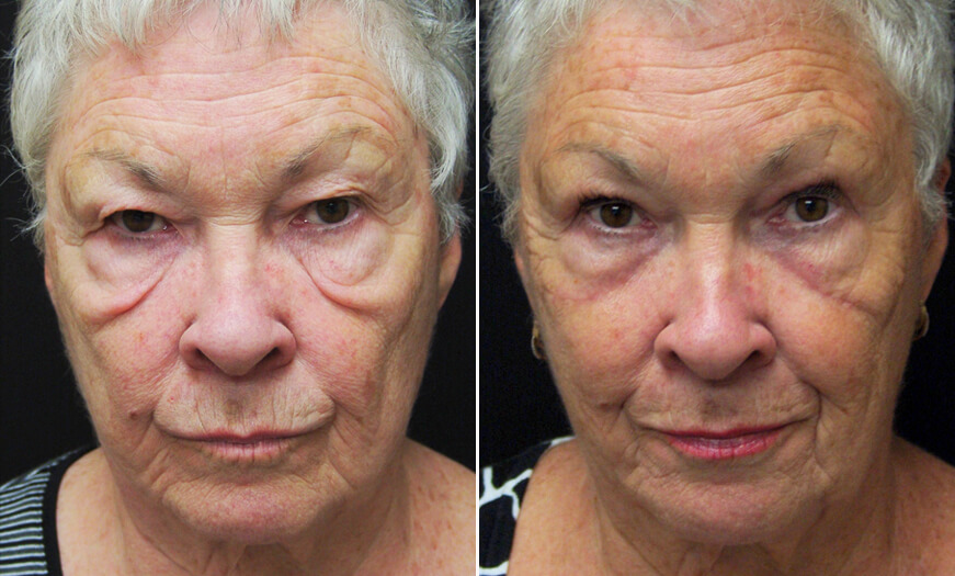 Blepharoplasty Before And After