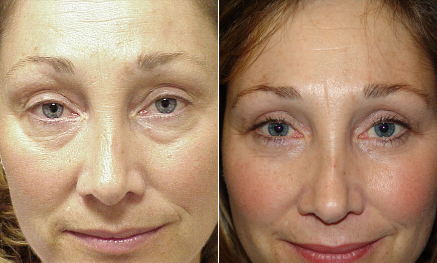 Eyelid Surgery Before And After