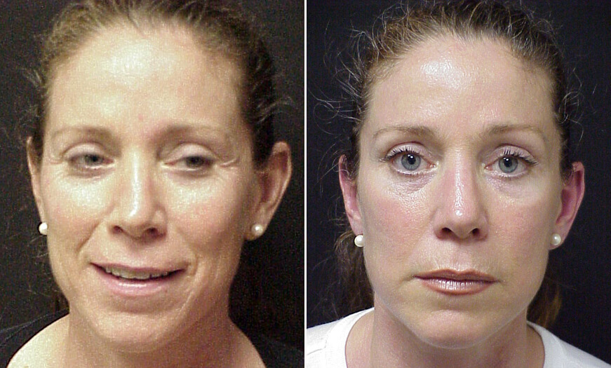 Botox Before And After