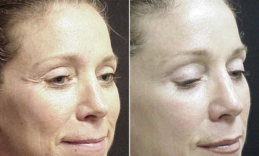 Botox Treatment Before And After