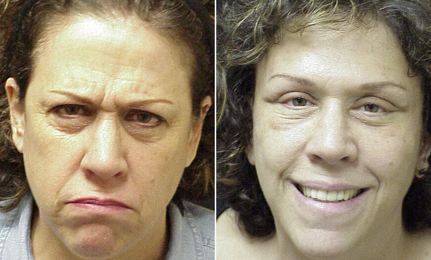 Before And After Botox Injections