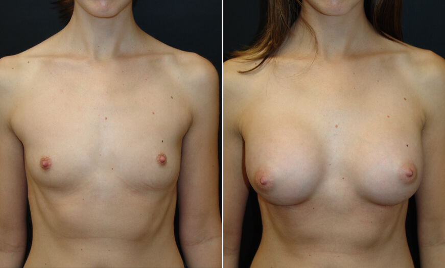 Before And After Breast Implant Surgery