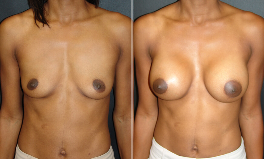 Breast Implants Before And After