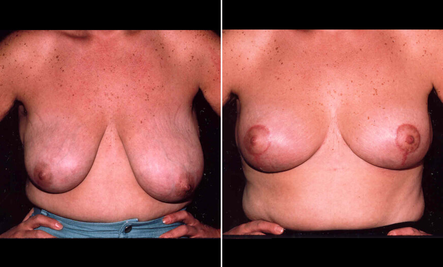 Breast Lift Before And After