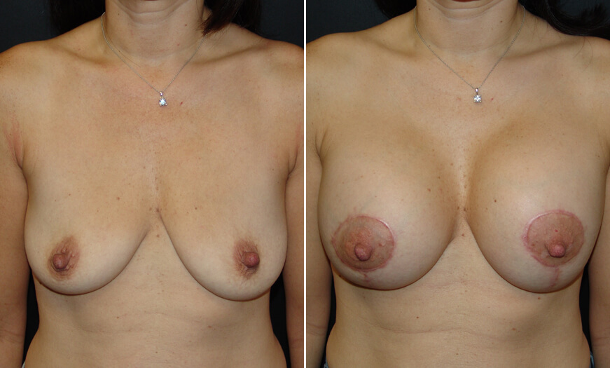 Mastopexy Before And After