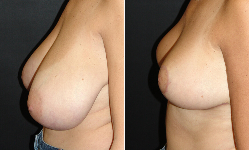 Breast Reduction Results