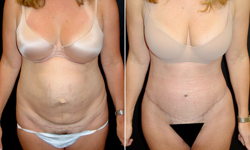 CORE Abdominoplasty Results