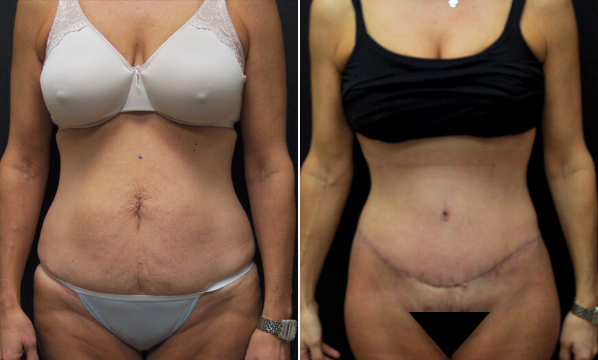 Before And After CORE Abdominoplasty Surgery