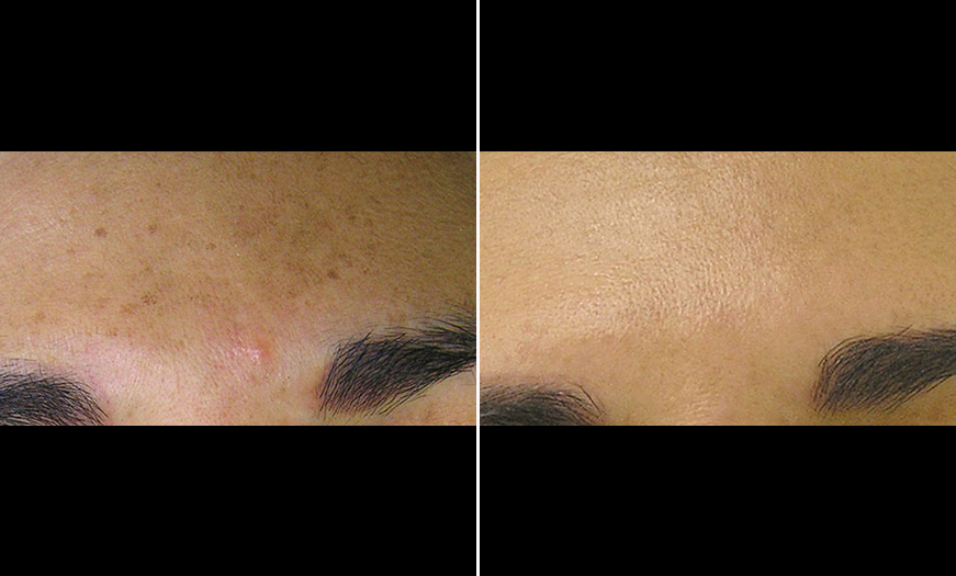 HydraFacial® Before And After