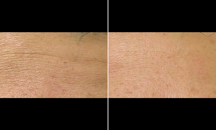 HydraFacial® Before & After