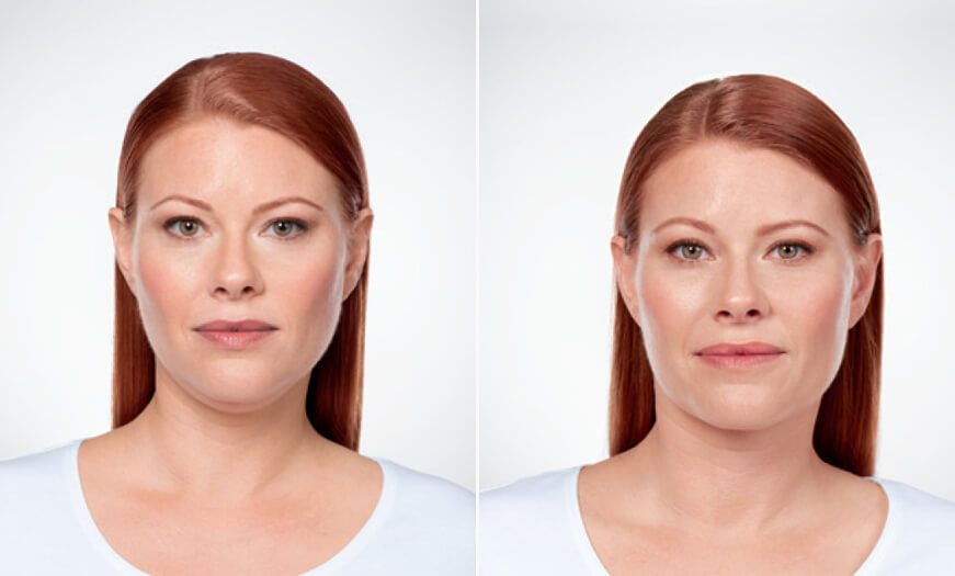 Kybella Before And After