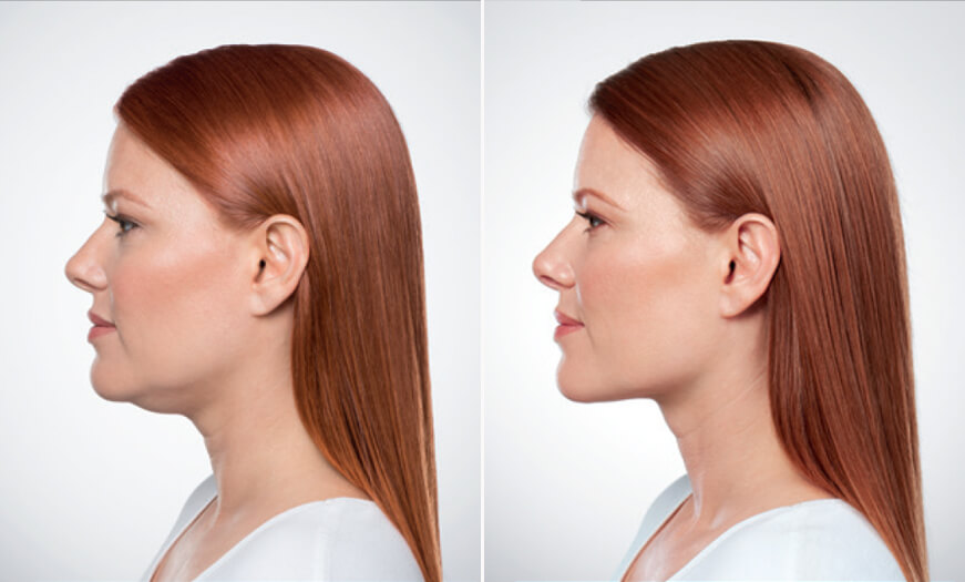 Kybella Treatment Before And After