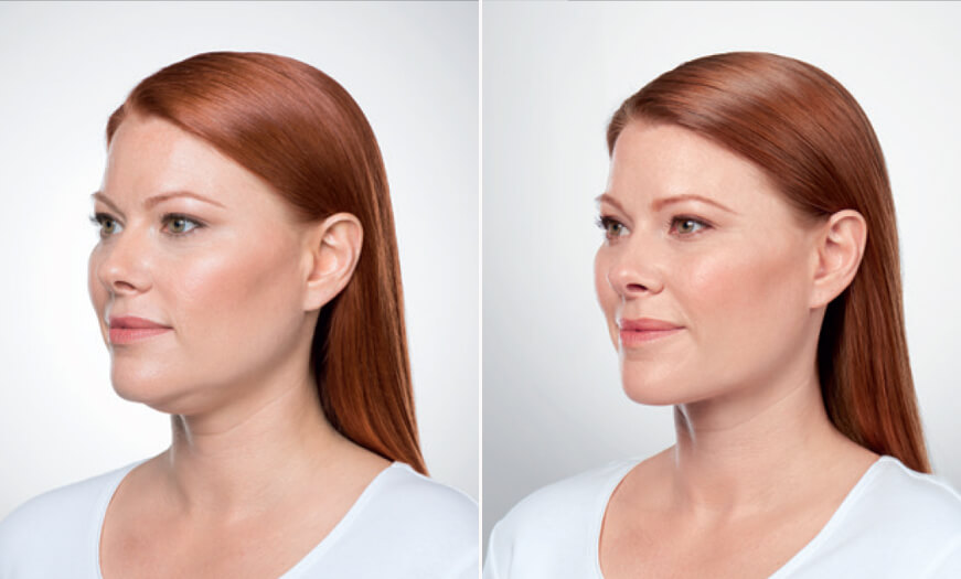 Before And After Kybella Injections