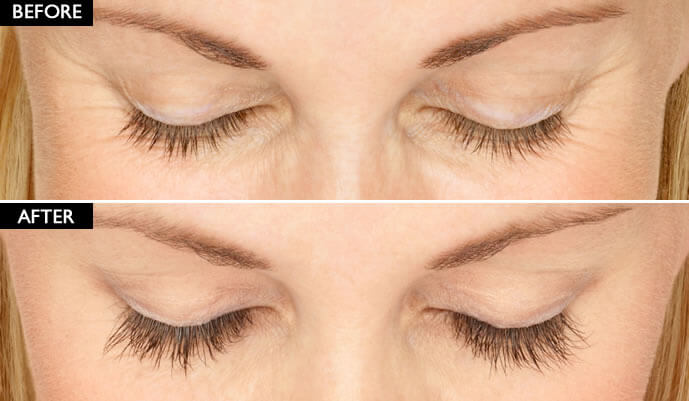 Latisse Eyelash Enhancer Before And After