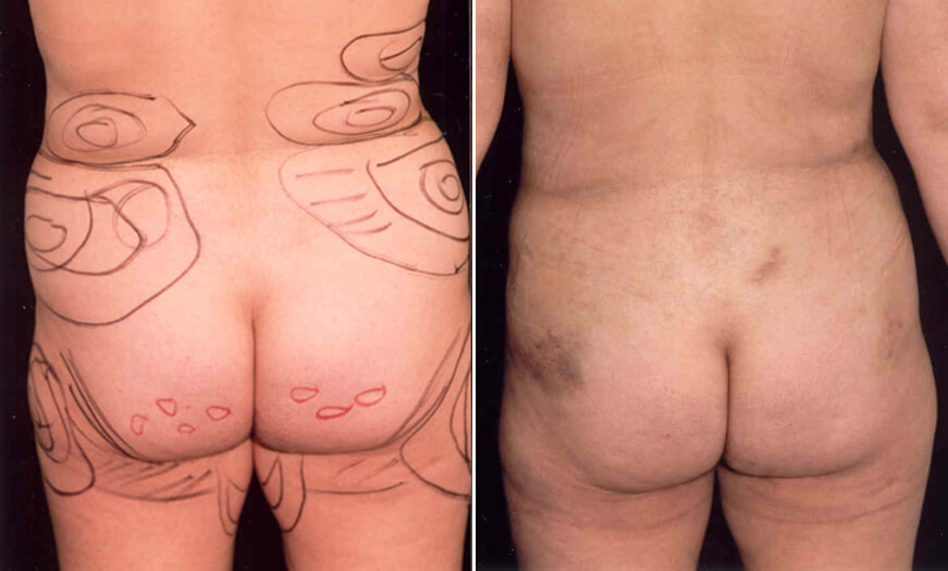 Before And After Liposucton Surgery