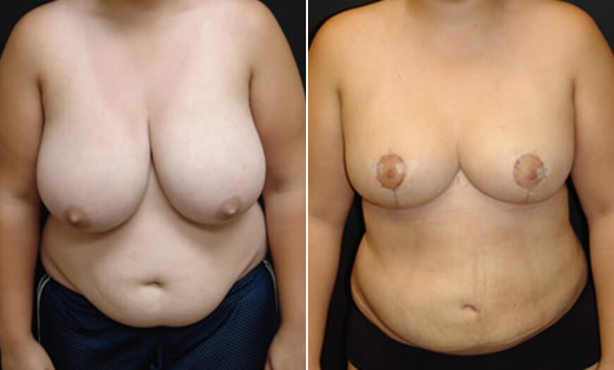 Before And After MAsterTuck Liposuction