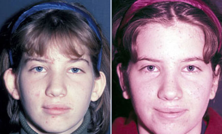 Otoplasty Before And After