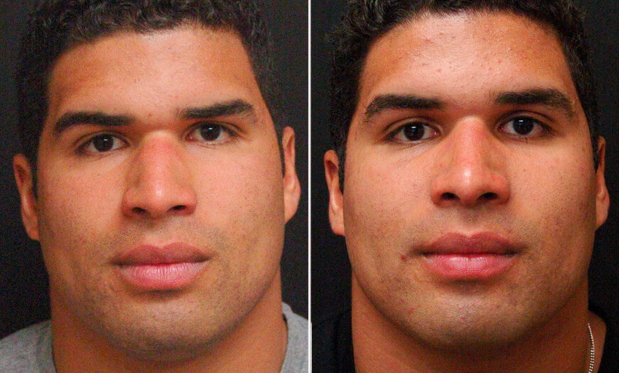 Rhinoplasty Before And After