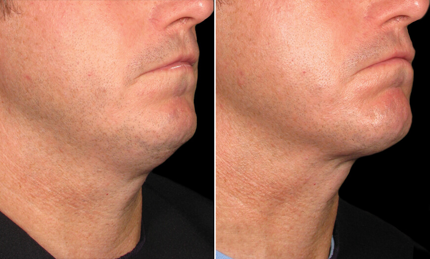 Ultherapy Results