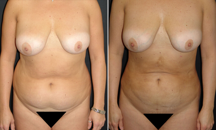 Before And After VASER Lipo