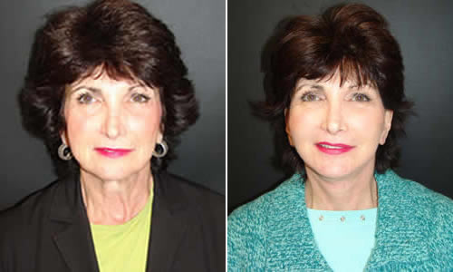 Before & After Face & Neck Lift Front View