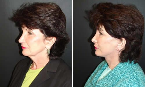 Before & After Face & Neck Lift Side Left View