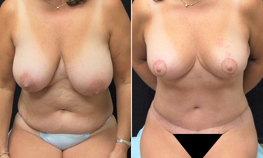 Before & After Core Abdominoplasty Front View