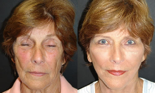 Before & After Face & Neck Lift Front View