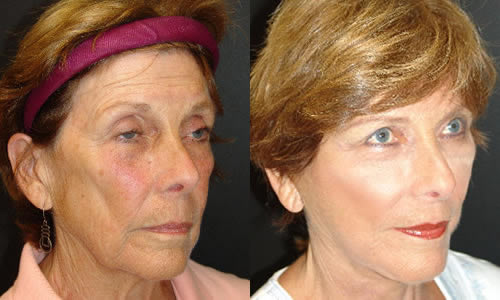 Before & After Face & Neck Lift Quarter Right View