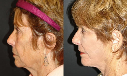 Before & After Face & Neck Lift Side Left View