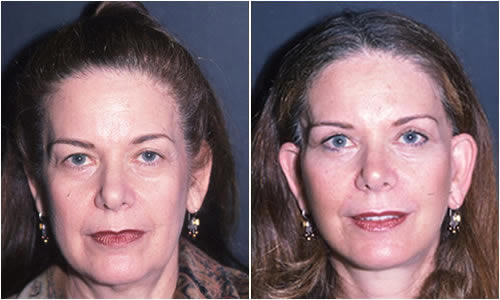 Before & After Face & Neck Lift Front View