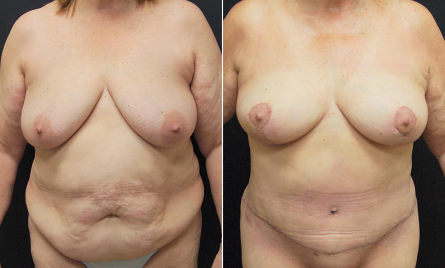 Before & After Core Abdominoplasty Front View