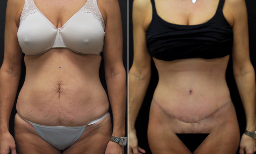 Before & After Core Abdominoplasty Front View