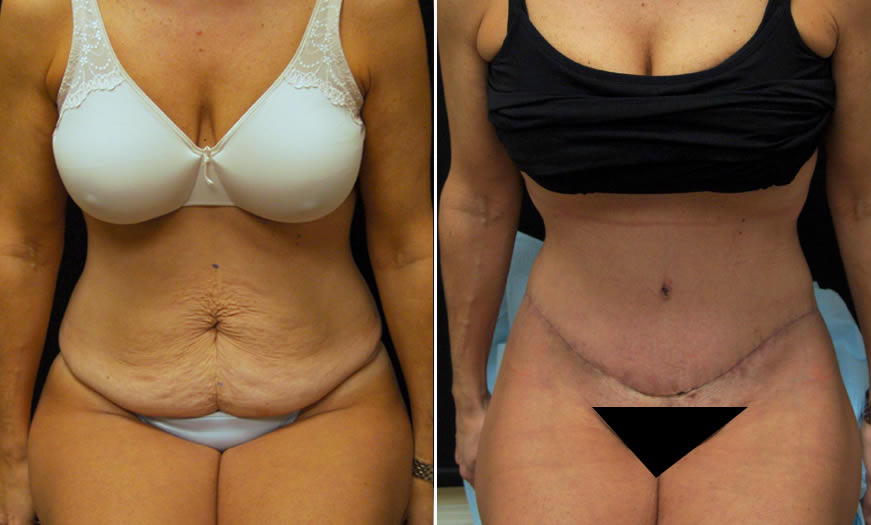 Before & After Core Abdominoplasty Front View Sitting