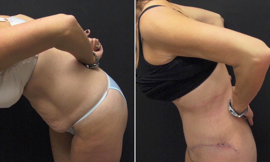 Before & After Core Abdominoplasty Quarter View Bent