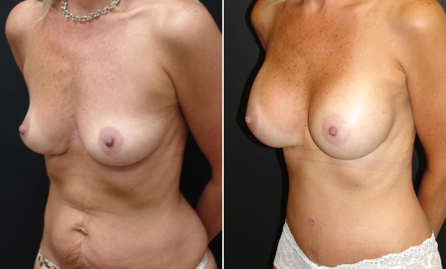 Before & After Core Abdominoplasty Quarter View