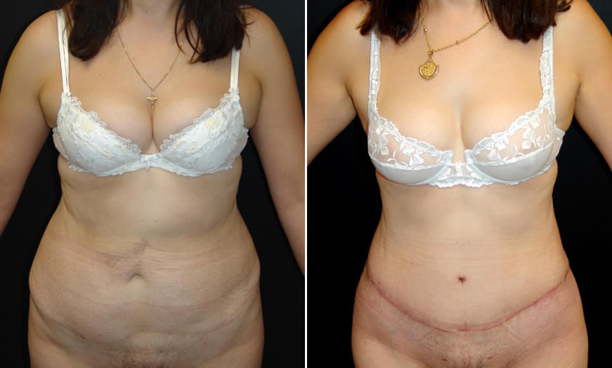 Before & After Core Abdominoplasty Front View