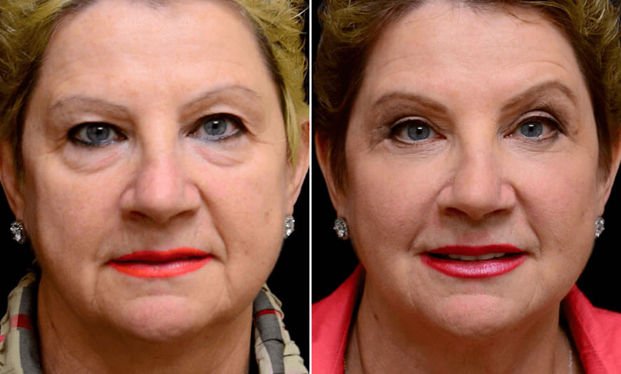 Before & After Blepharoplasty Front View