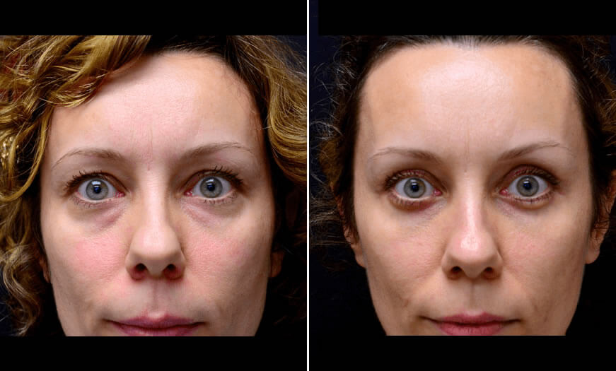 Before & After Blepharoplasty Front View 1