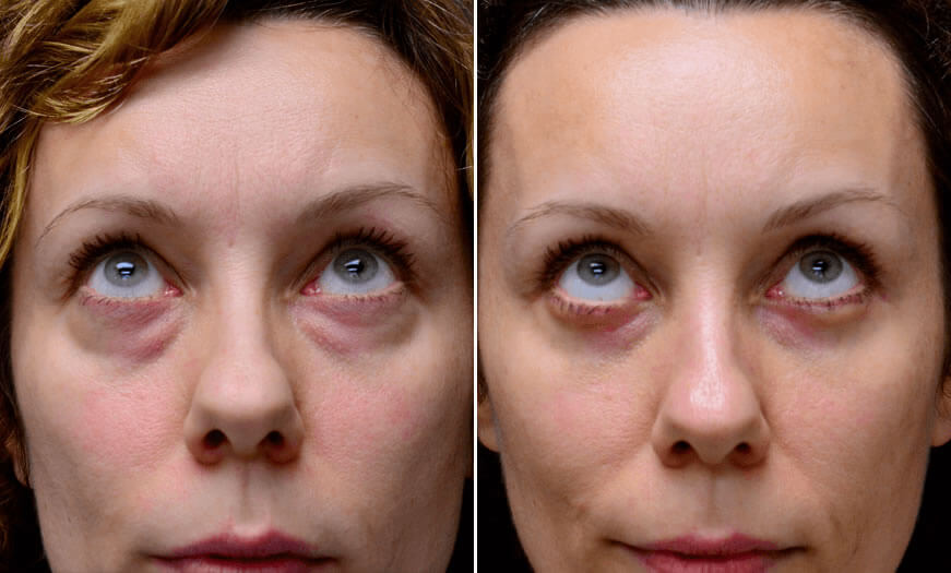 Before & After Blepharoplasty Front View 2