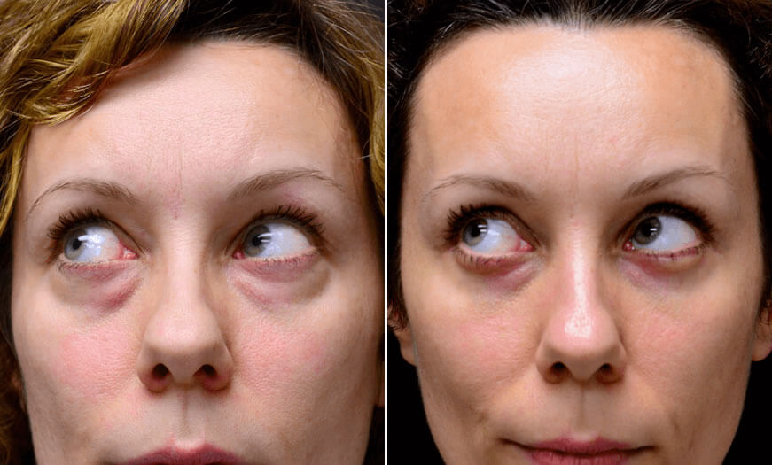Before & After Blepharoplasty Front View 3