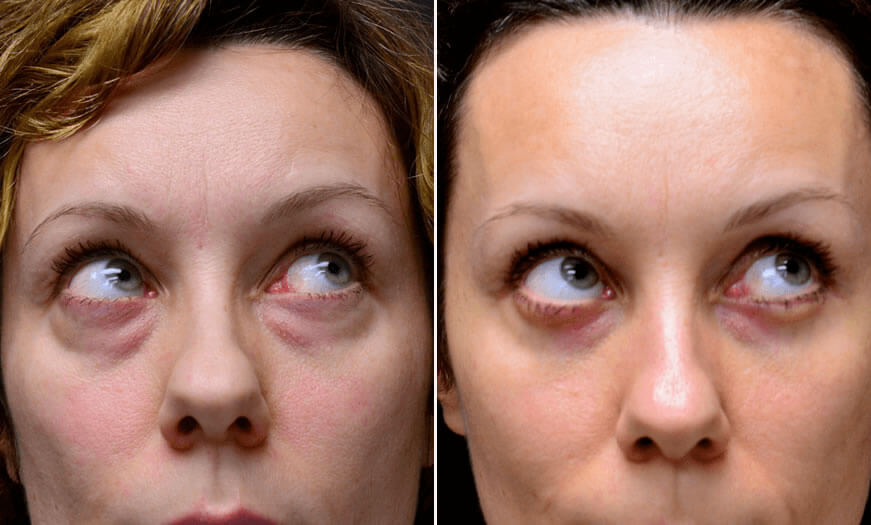 Before & After Blepharoplasty Front View 4