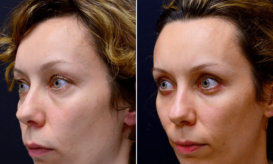 Before & After Blepharoplasty Quarter Left View