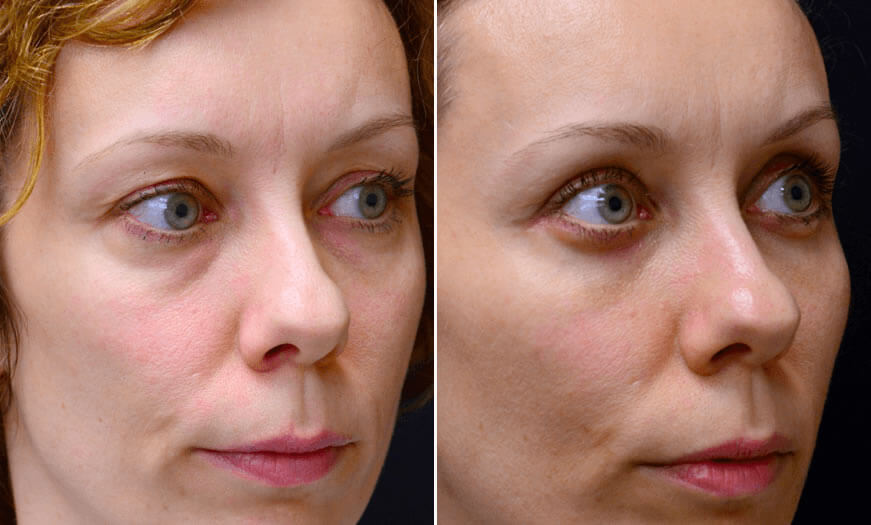 Before & After Blepharoplasty Quarter Right View