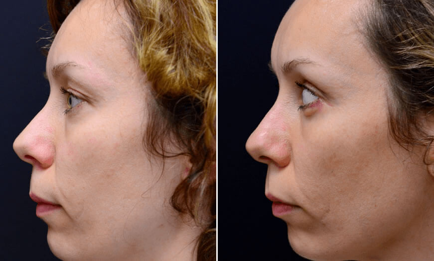 Before & After Blepharoplasty Side Left View