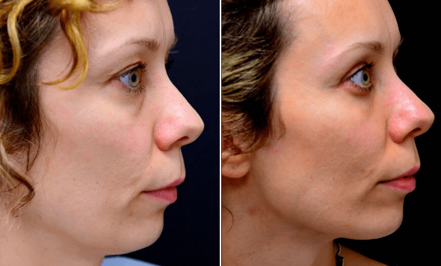 Before & After Blepharoplasty Side Right View