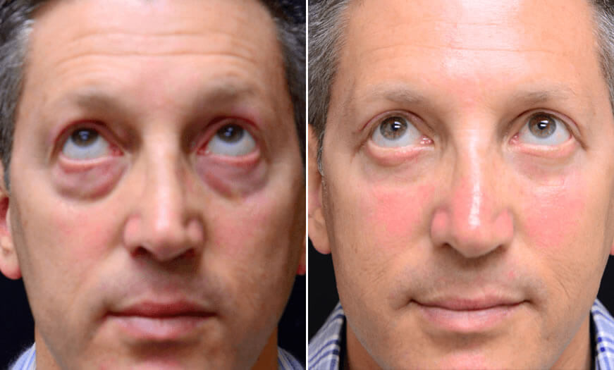 Before & After Blepharoplasty Front View 2