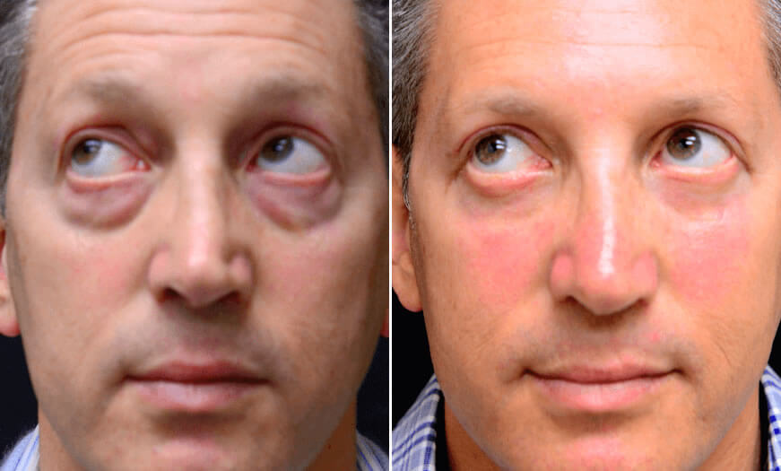 Before & After Blepharoplasty Front View 3